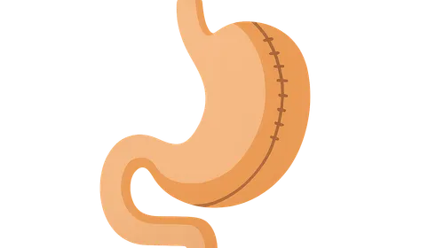 Bariatric surgery procedures and complications