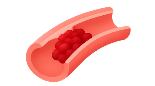 Thrombolysis in Emergency Settings