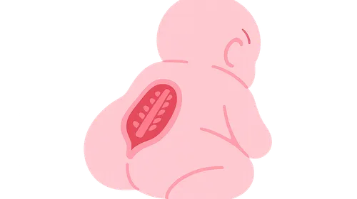 Neural tube defects