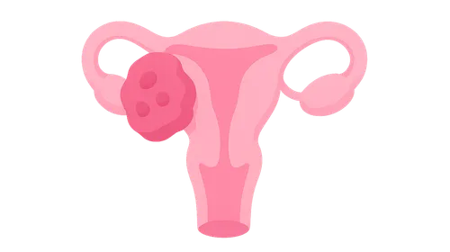 Vulvar and Vaginal Cancer