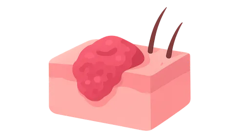 Basal Cell Carcinoma