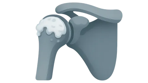 Osteoarthritis of Shoulder