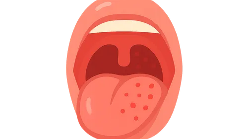 Pharyngitis