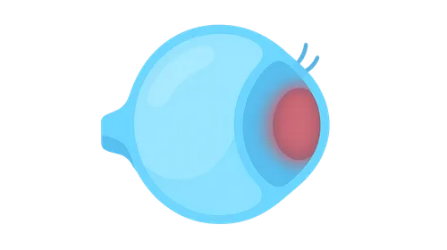 Scleritis: Posterior