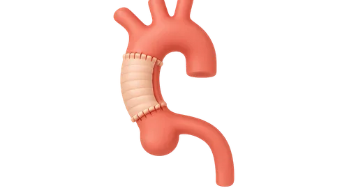 Aortic dissection management