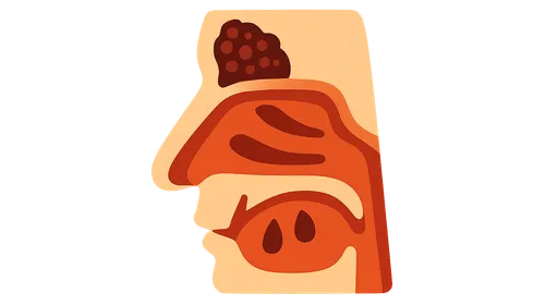 Invasive Fungal Sinusitis