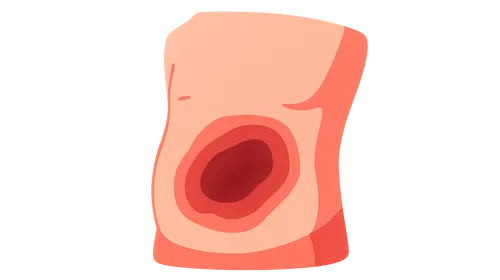 Blunt abdominal trauma