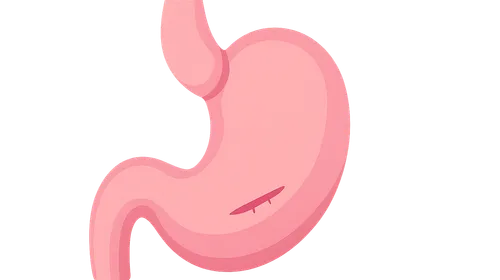 Pyloric stenosis diagnosis and pyloromyotomy
