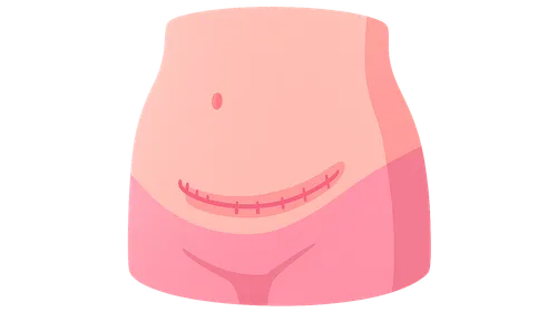 Recovery After Cesarean Delivery