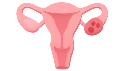 Female Factor Infertility