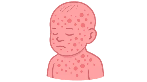 Neonatal candidiasis