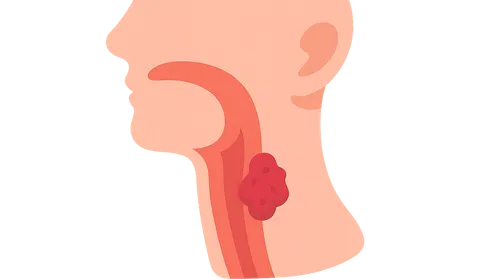 Hypopharyngeal Cancer