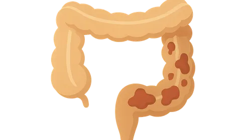 Inflammatory Bowel Disease