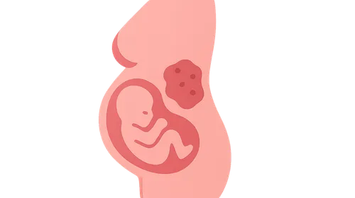 Maternal cancer in pregnancy