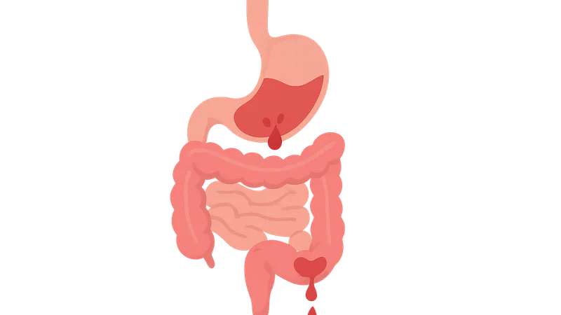 GI bleeding (upper and lower)