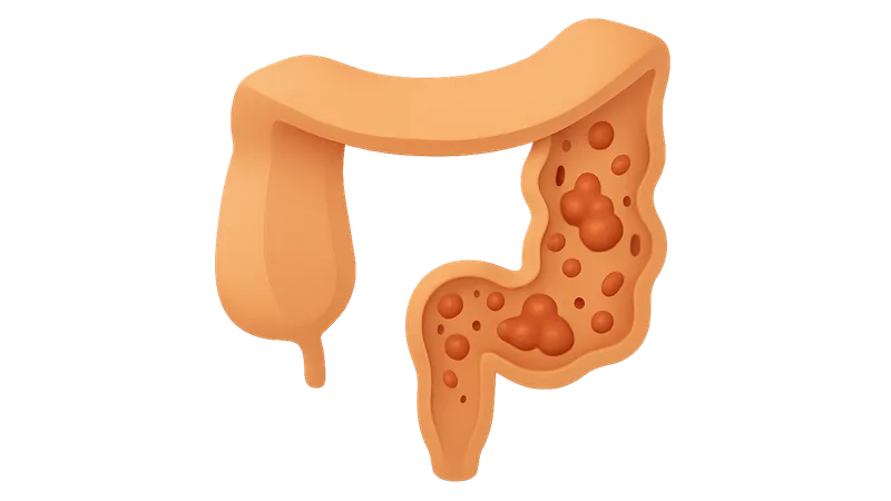 Crohn's disease pathophysiology
