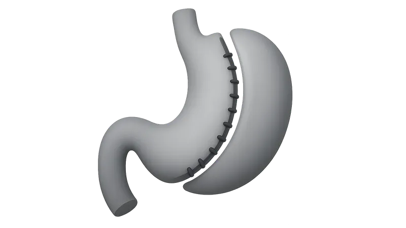 Revisional Bariatric Surgery