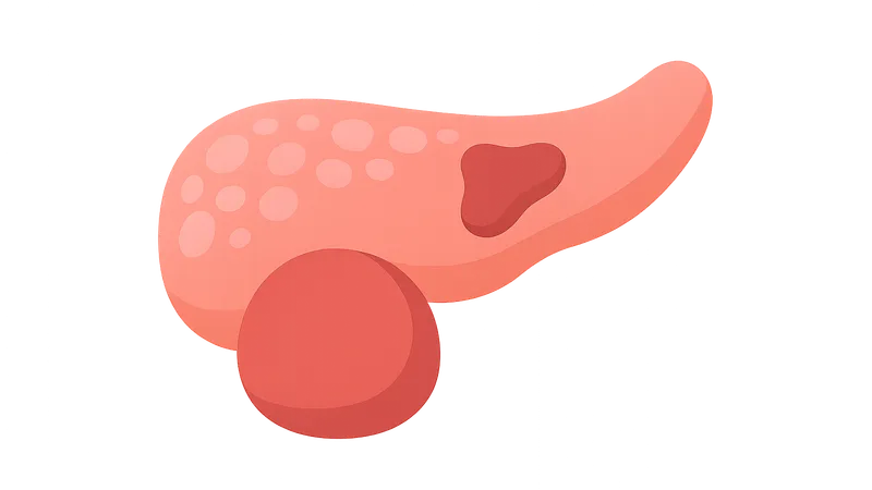 Local complications of acute pancreatitis