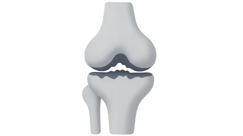 Osteoarthritis of Knee