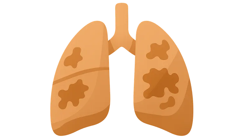 Idiopathic pulmonary fibrosis