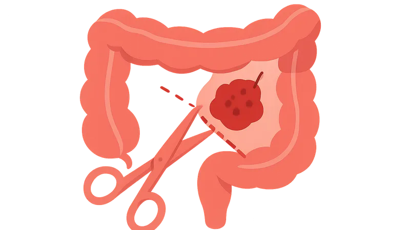 Colorectal cancer resection principles