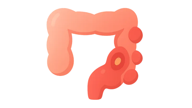 Diverticulitis
