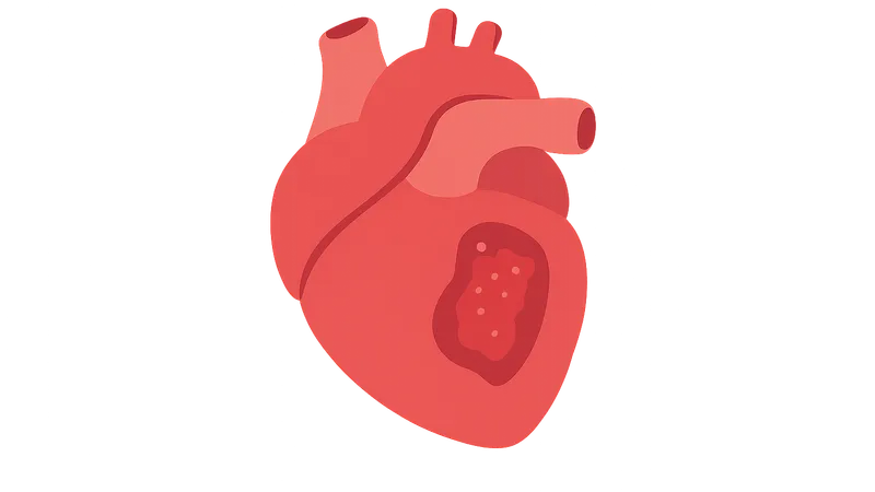 Infective endocarditis