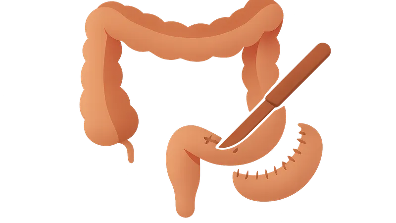 Surgical management in IBD