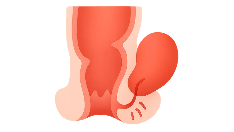 Anorectal Abscess and Fistula