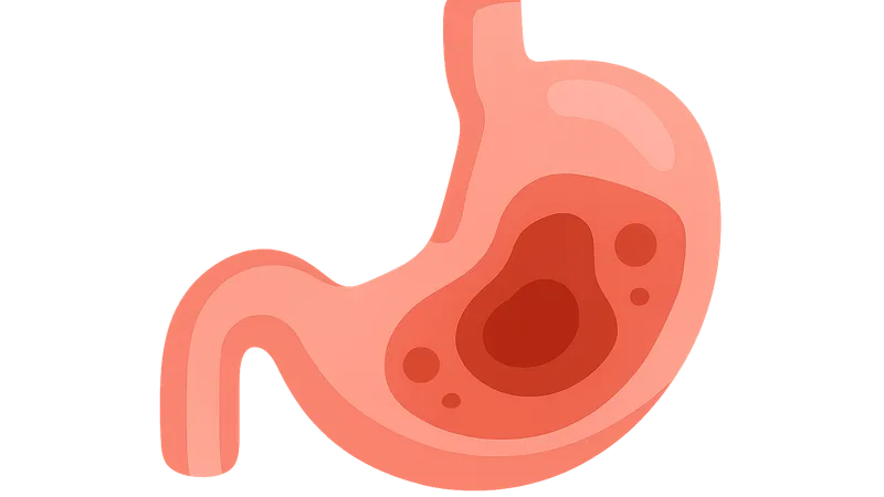Intra-abdominal infections
