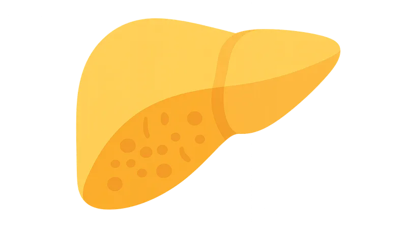 GSD type I (von Gierke disease)