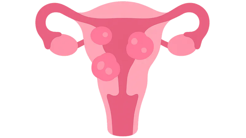 Uterine Fibroids