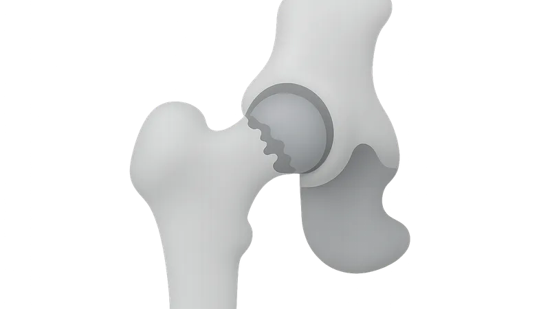 Osteoarthritis of Hip
