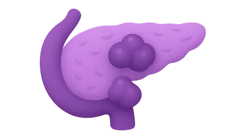 Neuroendocrine Tumors of Pancreas