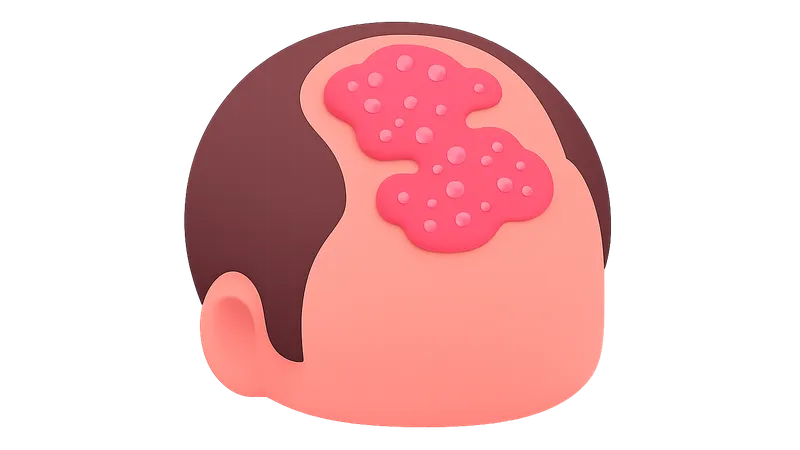 Scalp Psoriasis