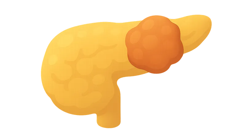 Pancreatic Neoplasms