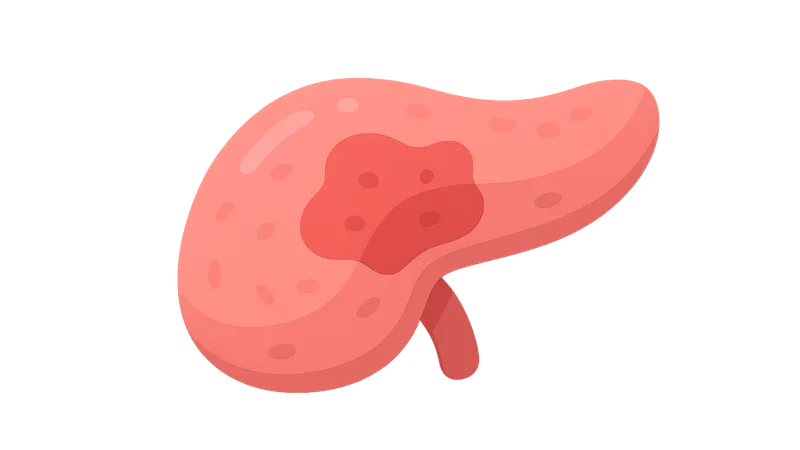 Severity assessment in acute pancreatitis