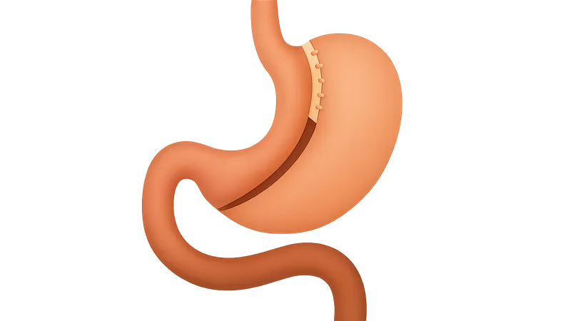 Malabsorptive Procedures