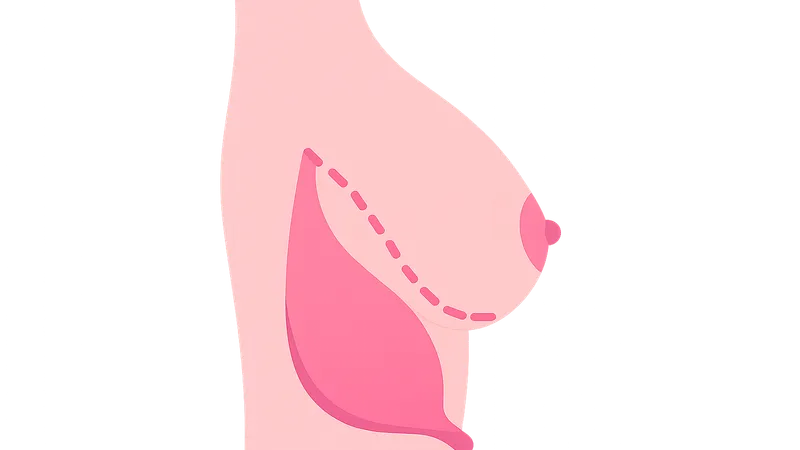 Breast Reconstruction Techniques