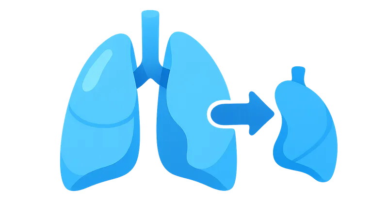 Lung transplantation