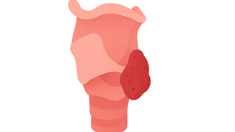 Hypopharyngeal Carcinoma