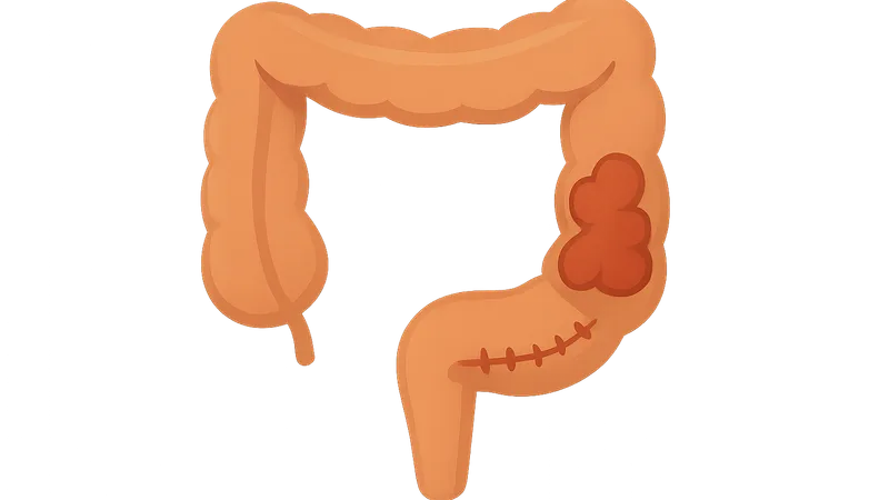 Inflammatory bowel disease surgical management