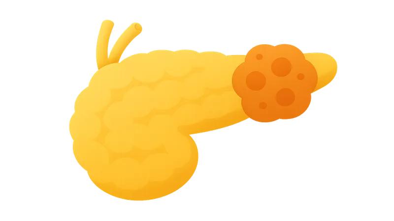 Pancreatic endocrine tumors