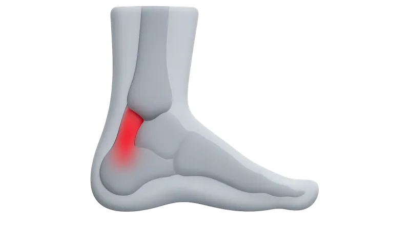 Achilles Tendon Disorders