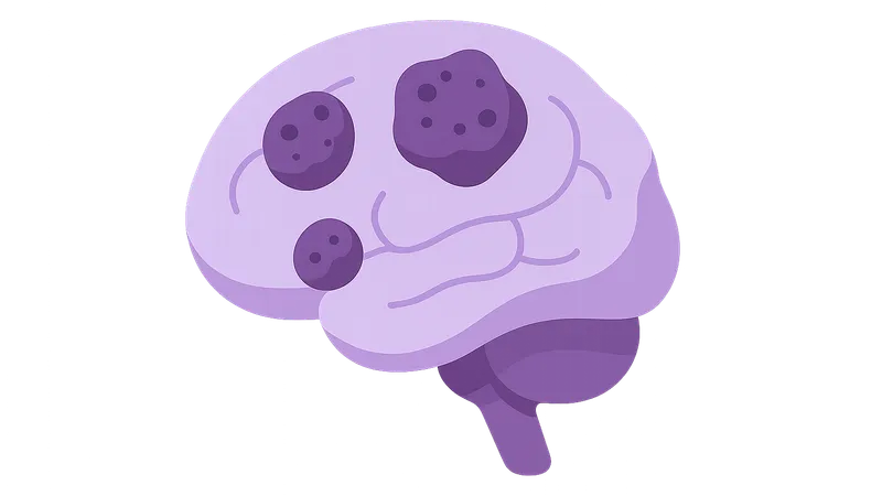 Metastatic CNS tumors