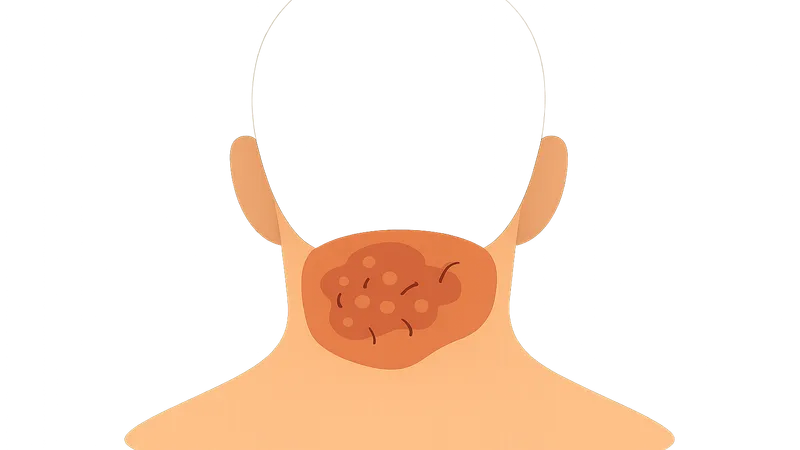 Acne Keloidalis Nuchae