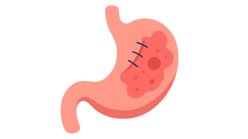 Wound complications (dehiscence, evisceration)
