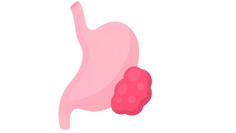 Salivary Gland Tumors