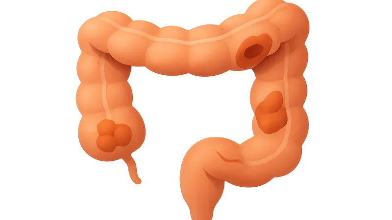 IBD-related complications