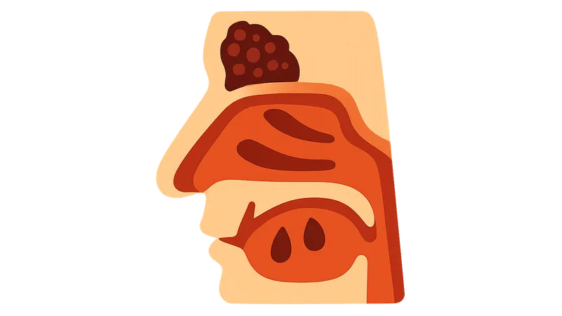 Invasive Fungal Sinusitis